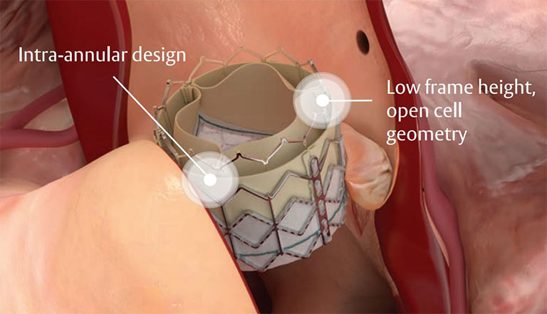 Illustration showing Edwards SAPIEN 3 valve-in-valve implantation