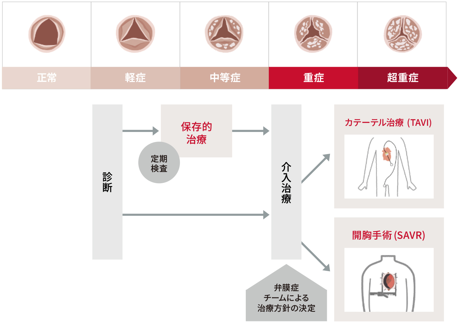 重症度に応じて保存的治療と介入治療（カテーテル治療：TAVI、開胸手術：SAVR）が行われる。