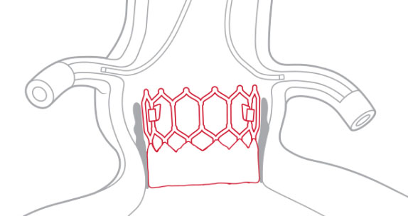 Coronory access SAPIEN 3 Ultra valve coronary access