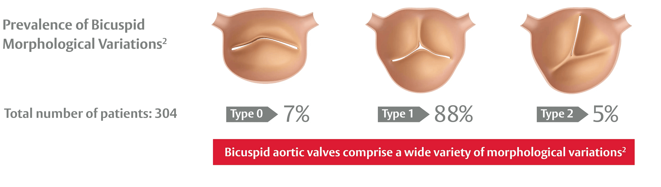 Bicuspid valve morphology Infographic titled 'Prevalence of Bicuspid Morphological Variations²'. Total number of patients: 304. Three schematic aortic valve views with labels and percentages: 'Type 0 — 7%', 'Type 1 — 88%', 'Type 2 — 5%'. Bottom banner text: 'Bicuspid aortic valves comprise a wide variety of morphological variations²'.