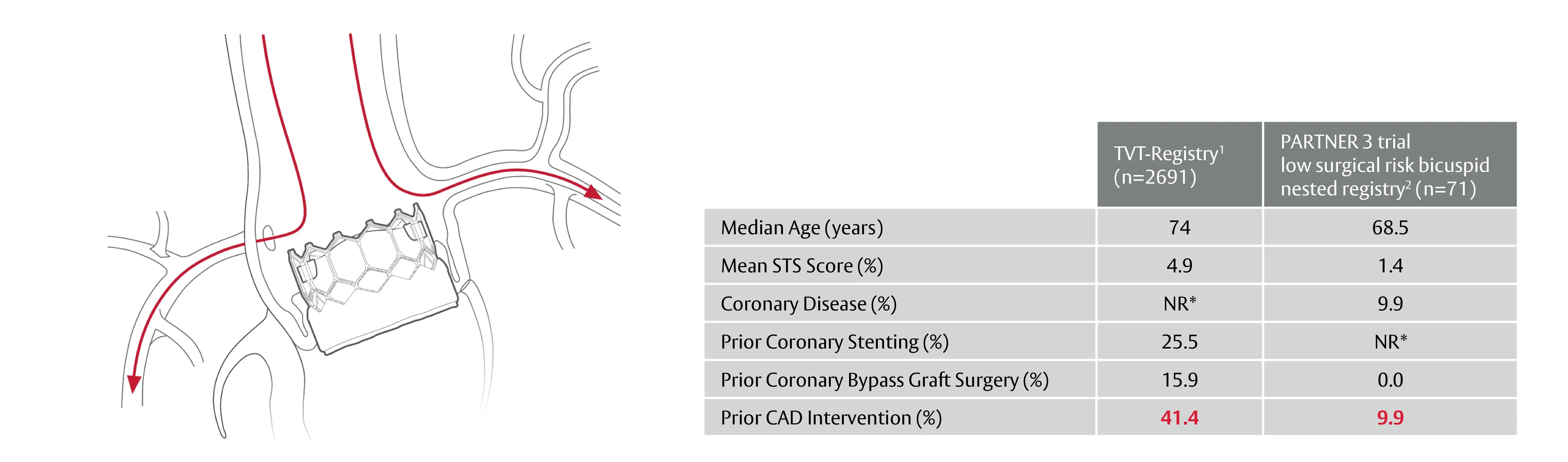 Illustration and data table about coronary access after TAVI. Left: line drawing of the aortic root with a transcatheter valve in place; a red arrowed path shows a catheter coursing from the aorta into a coronary artery. Right: comparison table with two columns — ‘TVT-Registry¹ (n=2691)’ and ‘PARTNER 3 trial low surgical risk bicuspid nested registry² (n=71)’. Rows: ‘Median Age (years): 74 | 68.5’; ‘Mean STS Score (%): 4.9 | 1.4’; ‘Coronary Disease (%): NR* | 9.9’; ‘Prior Coronary Stenting (%): 25.5 | NR*’; ‘Prior Coronary Bypass Graft Surgery (%): 15.9 | 0.0’; ‘Prior CAD Intervention (%): 41.4 | 9.9’. (*NR = Not Reported.)