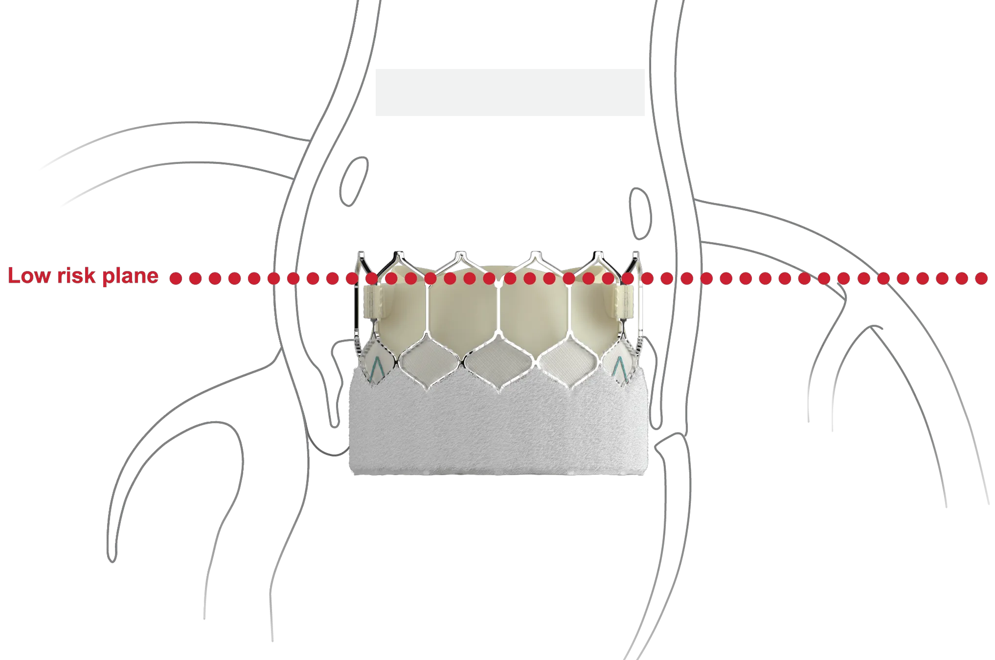 Image of graphic showing design to host future valve reinterventions